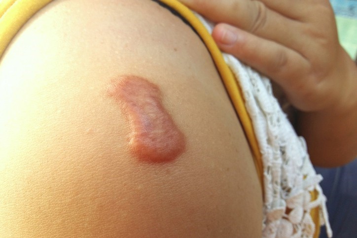 Sẹo lồi có thể gây ngứa, rát