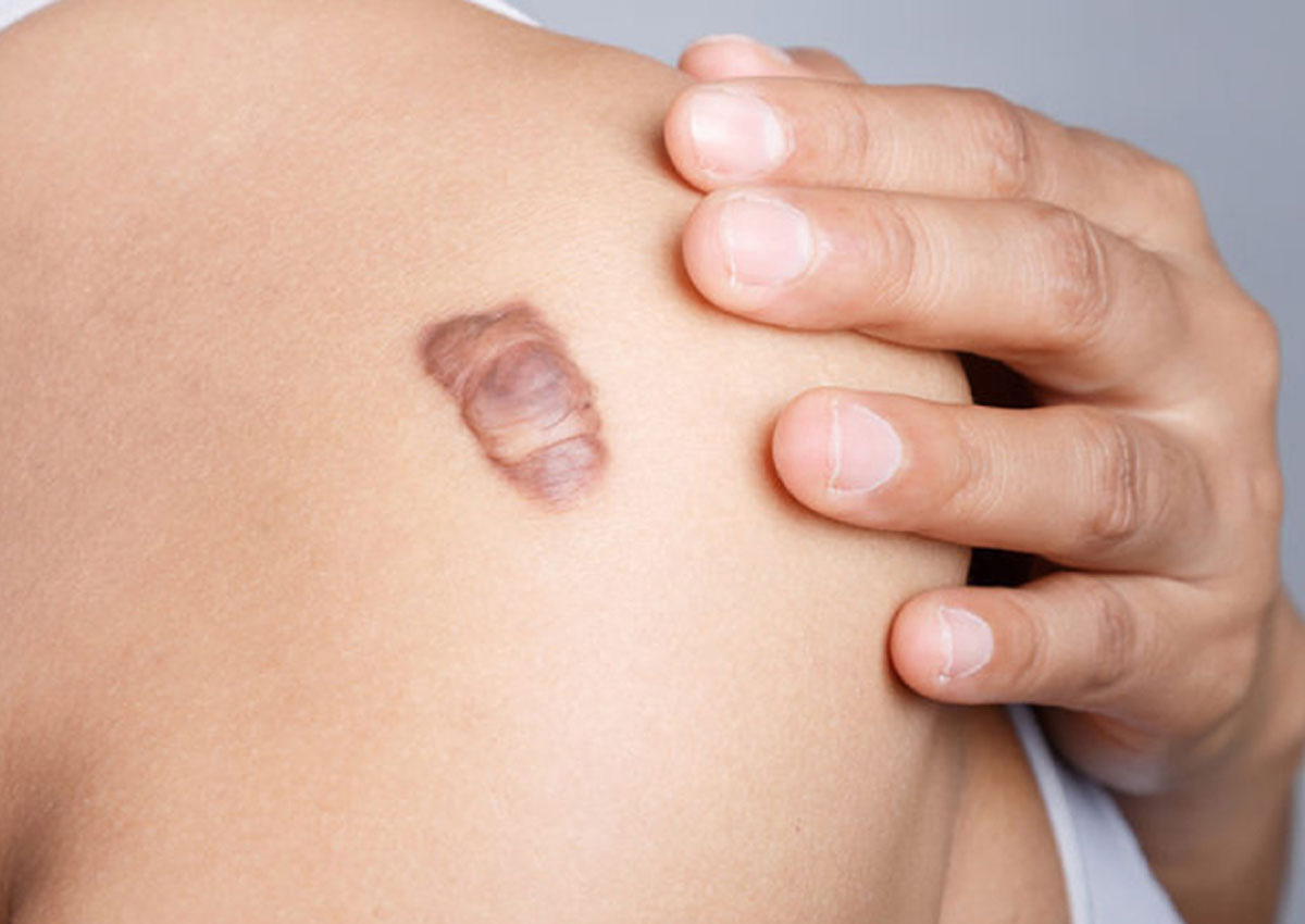 Sẹo lồi, sẹo phì đại hình thành do mô sợi quá dày