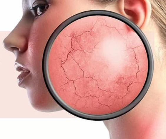 Sử dụng corticoid kéo dài gây nhiều tác dụng phụ trên da