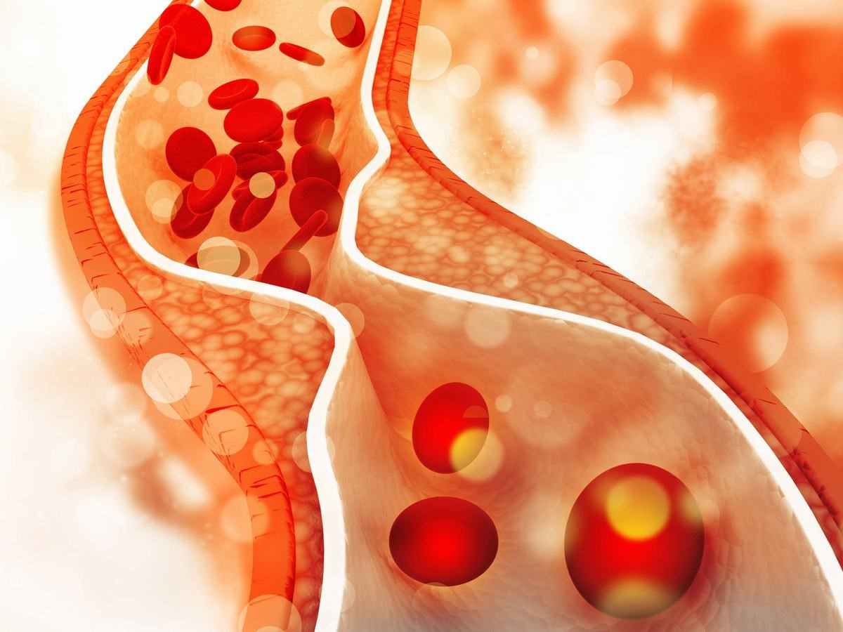 tắc nghẽn mạch máu