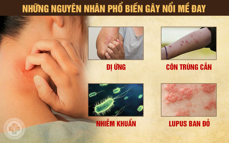 Tác nhân dị ứng gây nổi mề đay rất đa dạng
