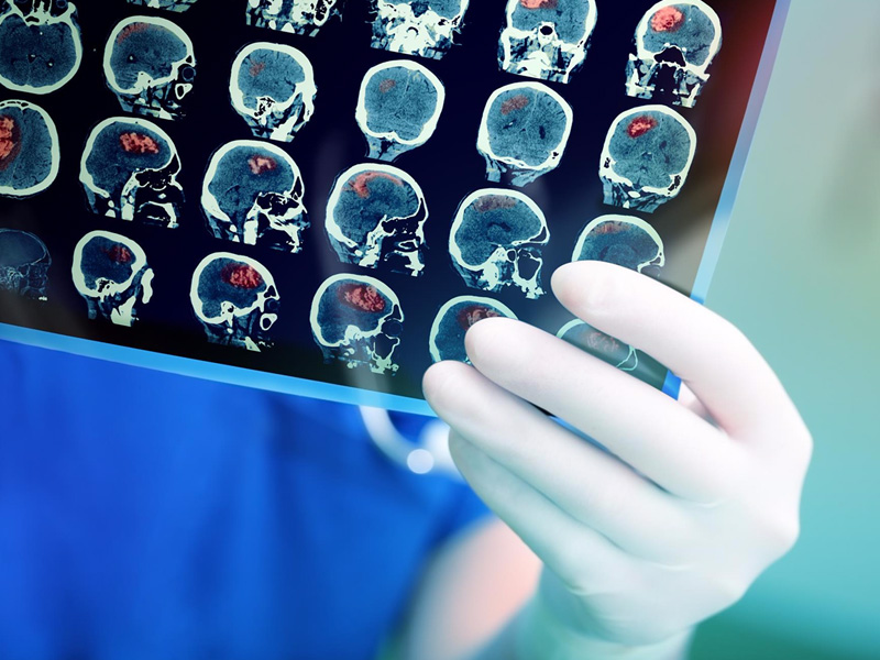 hình ảnh tai biến mạch máu não