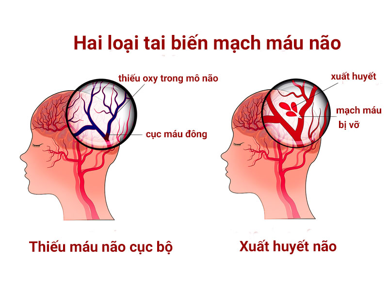 tai biến ở người già