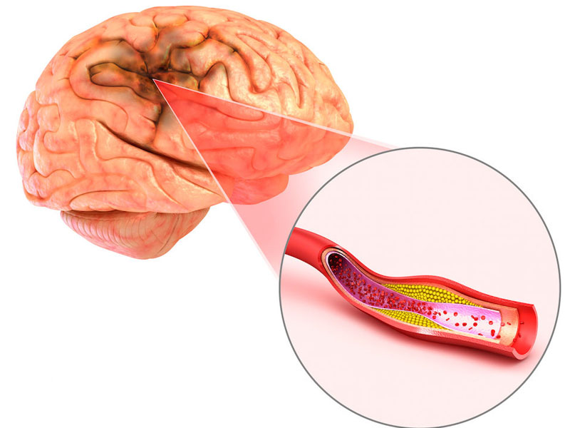 dấu hiệu tai biến nhẹ