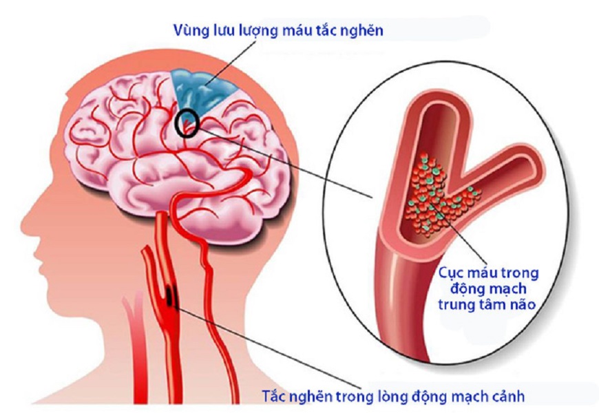 một số vùng dễ bị tai biến nhẹ 