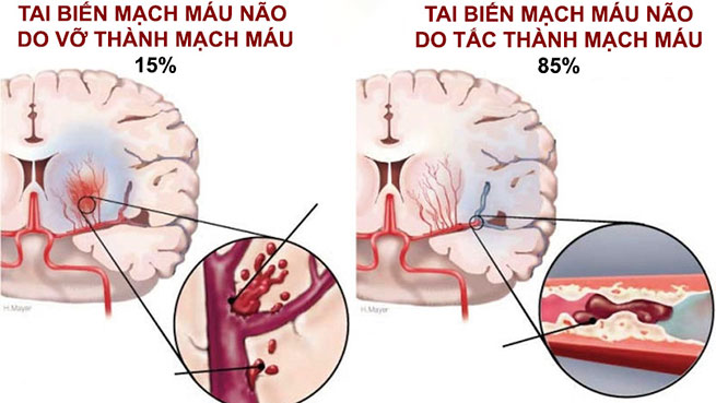 tai biến mạch máu não