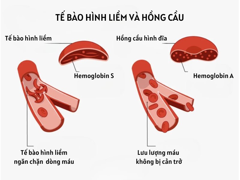 Tế bào hình liềm và hồng cầu bình thường