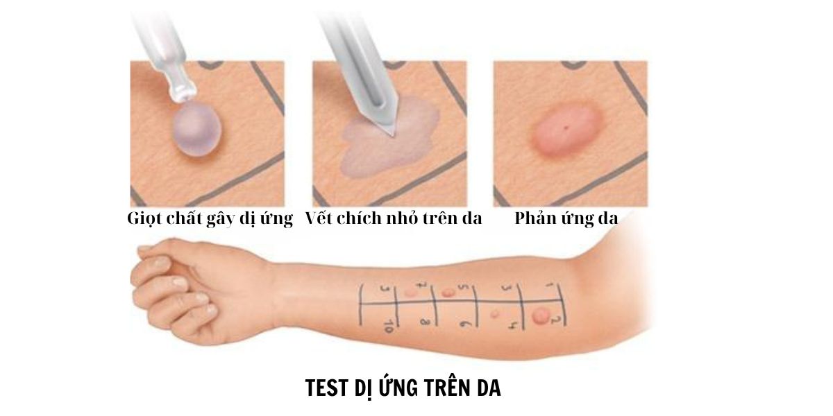 Test dị ứng nhằm xác định tác nhân gây dị ứng