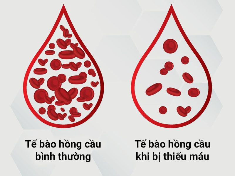 thiếu máu bổ sung gì