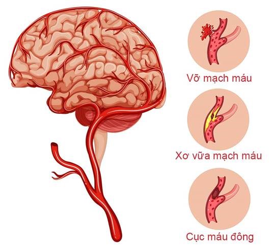 thiếu máu lên não có biểu hiện gì