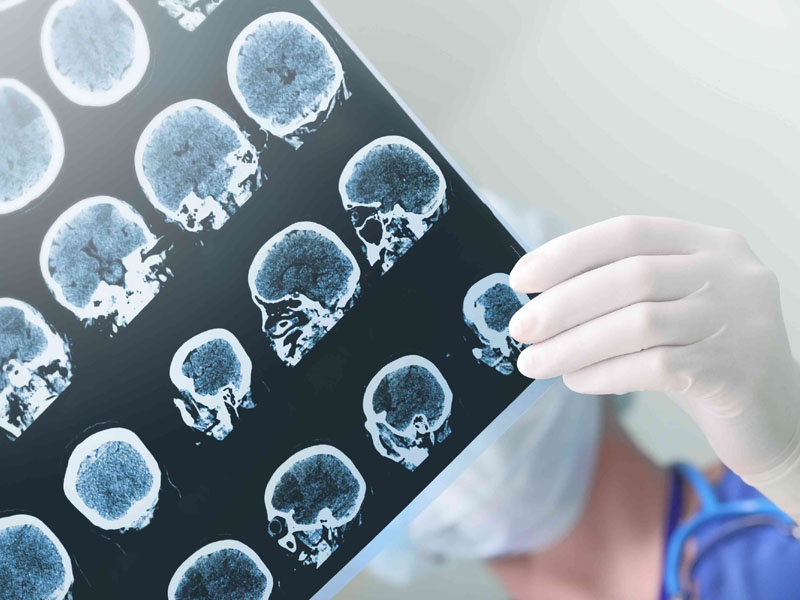 hiện tượng thiếu máu lên não