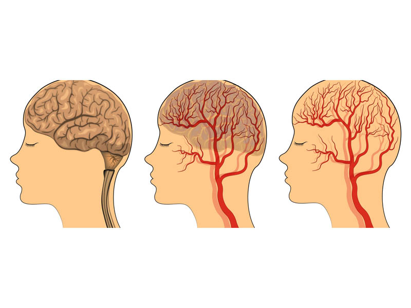 hiện tượng thiếu máu lên não