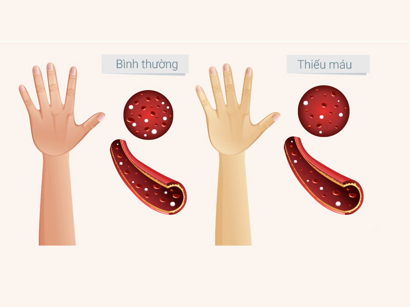 thiếu máu thiếu sắt