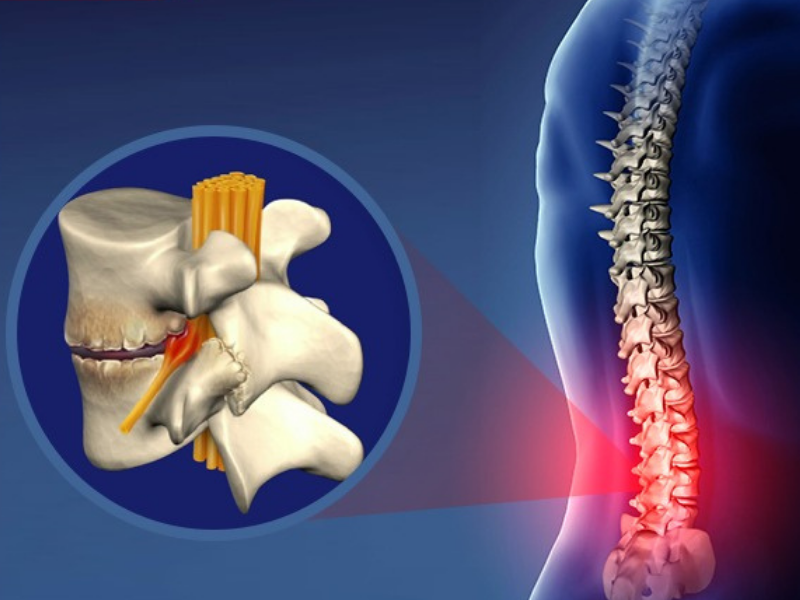 Thoái hóa cột sống cần điều trị, tránh để lâu gây biến chứng