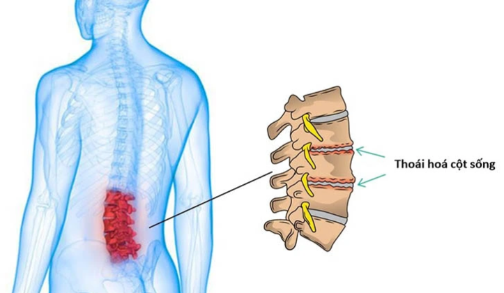 Thoái hóa cột sống gây áp lực lên tủy sống và dây thần kinh