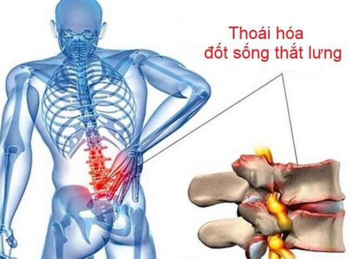 Thoái hóa đốt sống thắt lưng là nguyên nhân phổ biến gây chèn ép, đau dây thần kinh tọa