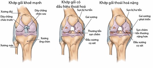 thoái hóa khớp gối 