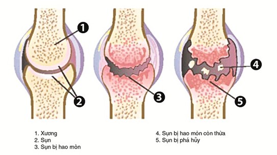 triệu chứng thoái hóa khớp gối