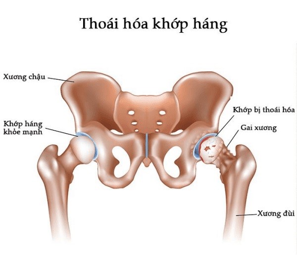 Thoái hóa khớp háng