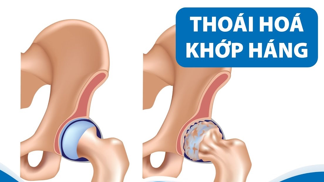 Thoái hóa khớp háng là một bệnh lý ngày càng trẻ hóa