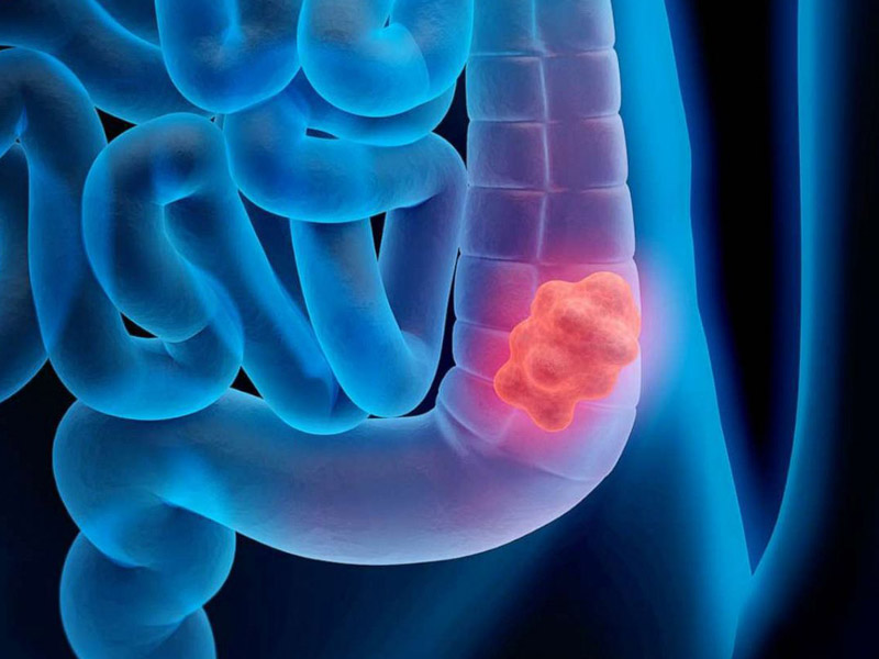 Tiêu chảy ra máu 