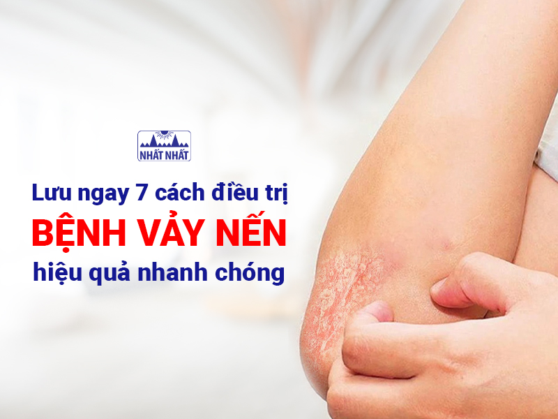 Tìm hiểu cách điều trị bệnh vẩy nến
