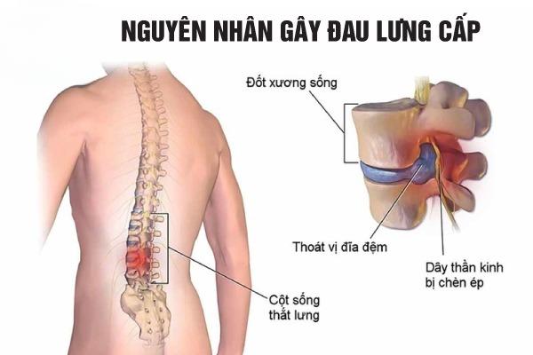 Tìm hiểu nguyên nhân đau lưng cấp tính