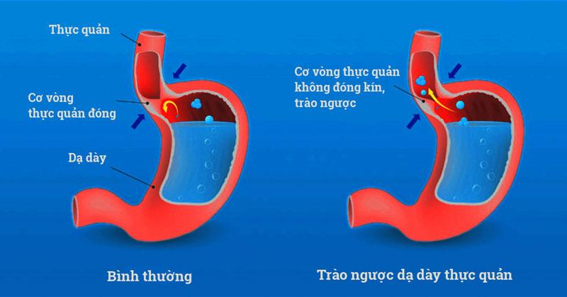 Tìm hiểu nguyên nhân gây trào ngược dạ dày thực quản để điều trị hiệu quả