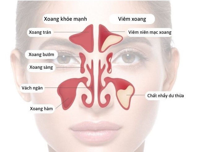Tình trạng viêm khiến dịch nhầy tiết ra nhiều hơn, dẫn đến nghẹt mũi xoang