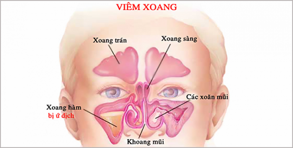 toa thuốc trị viêm xoang