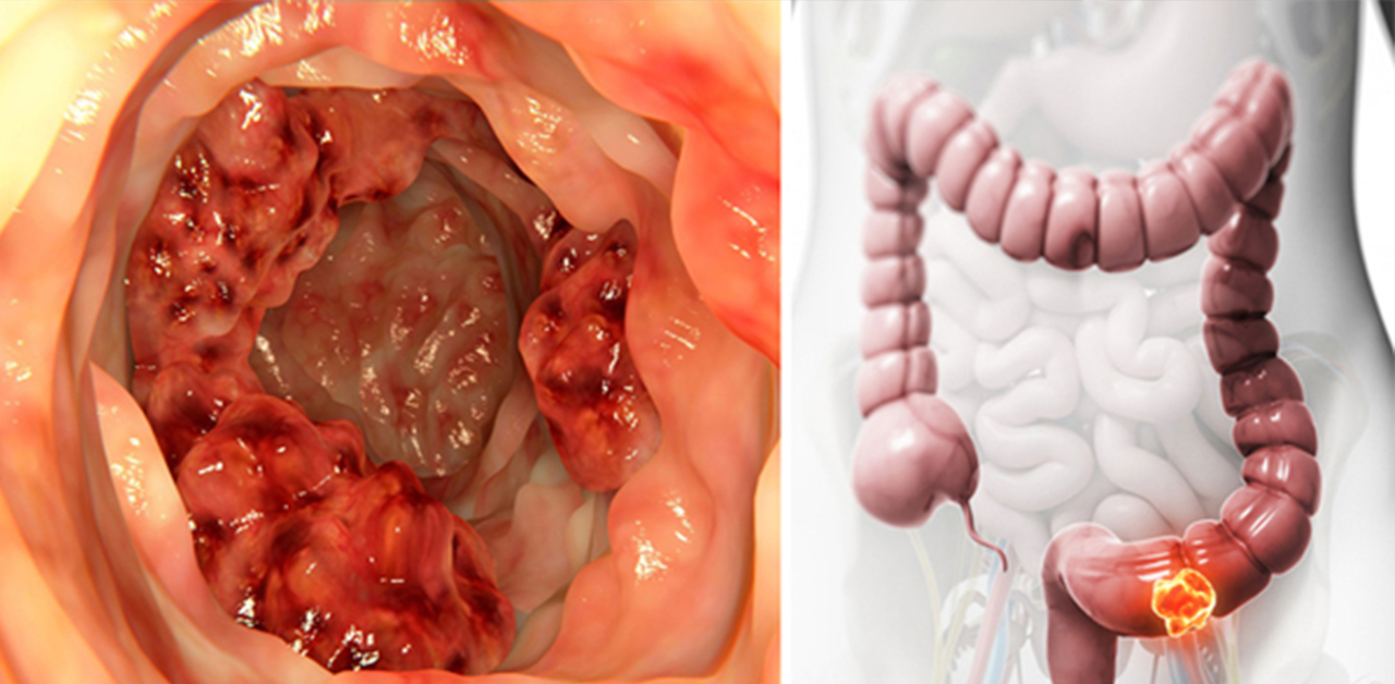 Tổn thương trong bệnh viêm đại tràng chảy máu