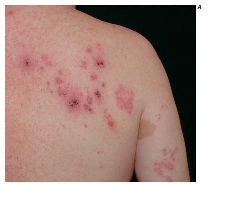 Tổn thương zona thần kinh thường ở một bên cơ thể