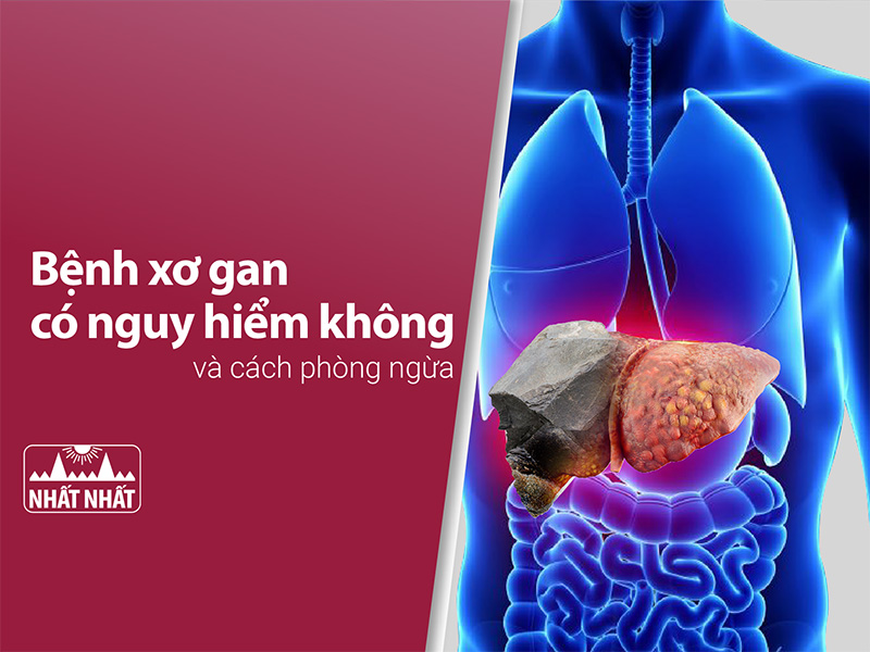xơ gan có nguy hiểm không