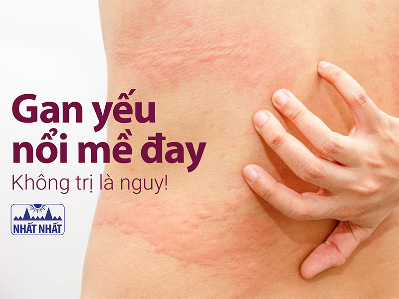 gan yếu nổi mề đay
