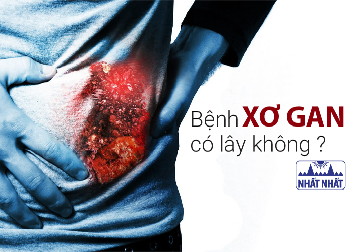 bệnh xơ gan có lây không