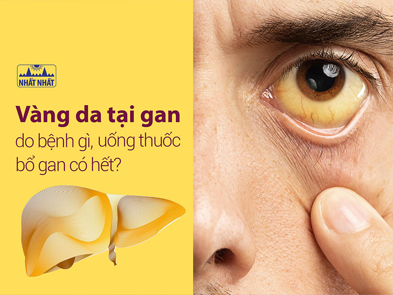 vàng da tại gan