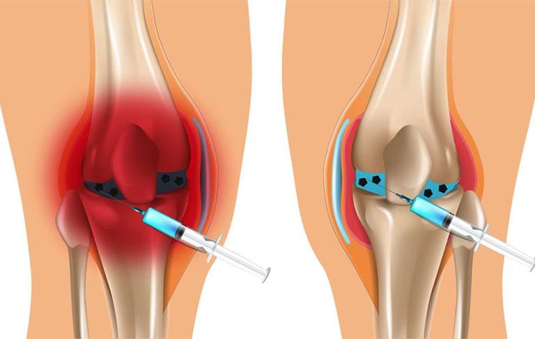 viêm khớp gối tràn dịch