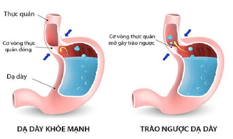 chữa trào ngược dạ dày