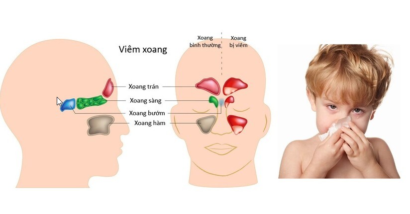 trẻ bị ngạt mũi