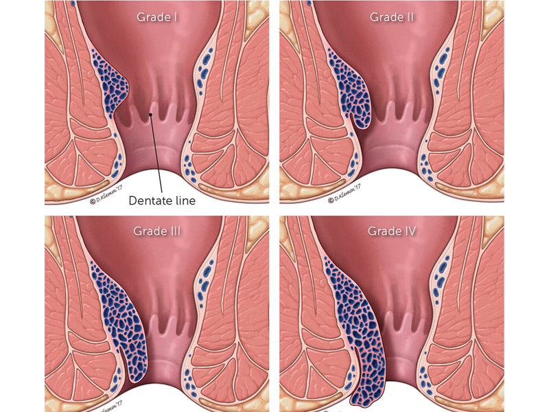 bệnh trĩ các cấp độ