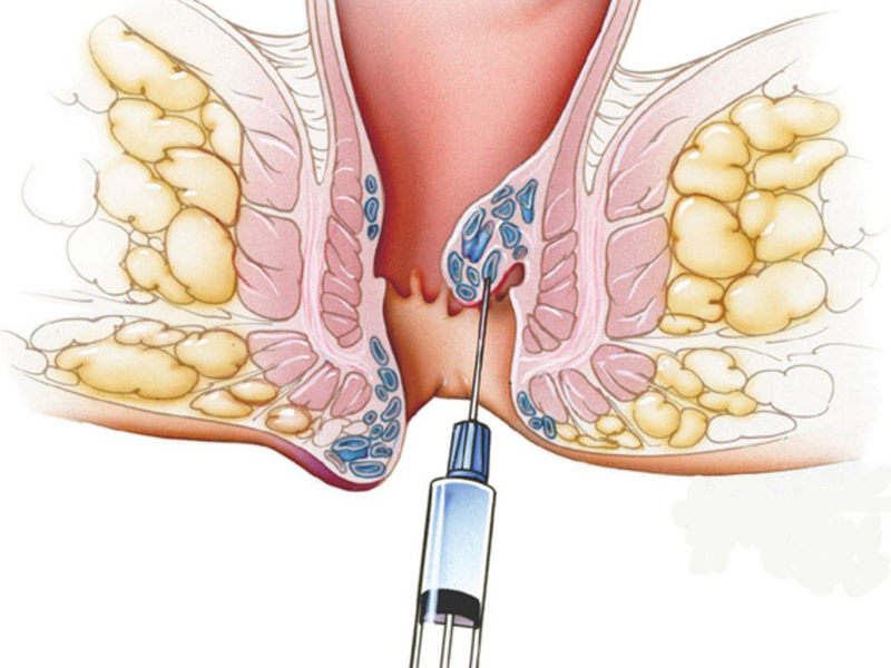 bệnh trĩ các cấp độ