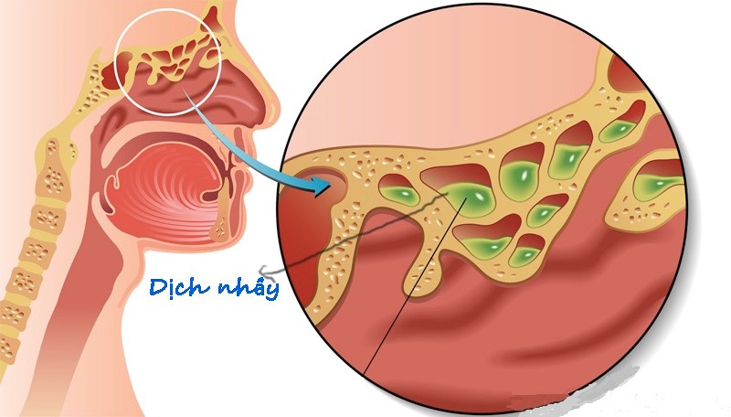cách trị nghẹt mũi cho trẻ
