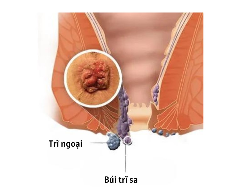 Trĩ ngoại và búi trĩ sa