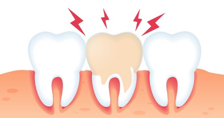 trị nhức răng tại nhà