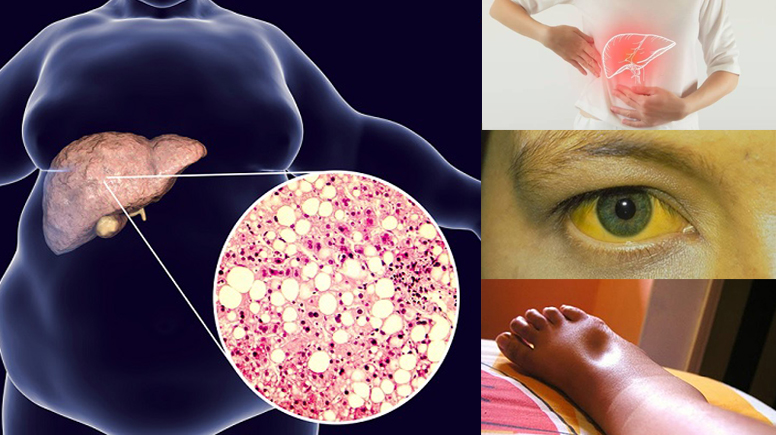 Triệu chứng bệnh gan nhiễm mỡ độ 2