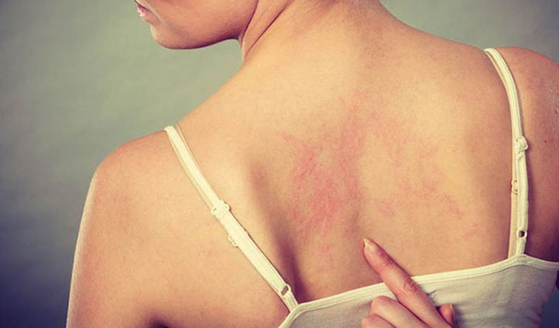 Triệu chứng bệnh mề đay