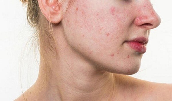 triệu chứng bệnh gan nóng