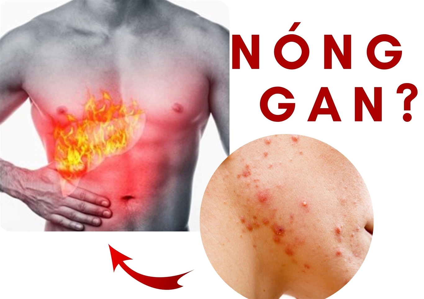 triệu chứng bệnh gan nóng