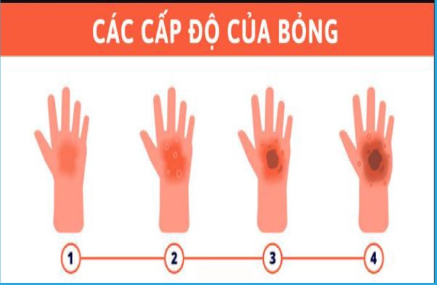 Triệu chứng phồng nước thường xuất hiện trong bỏng độ 2