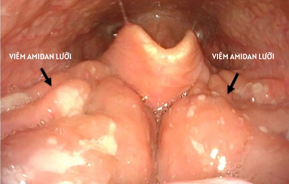 Triệu chứng viêm amidan lưỡi